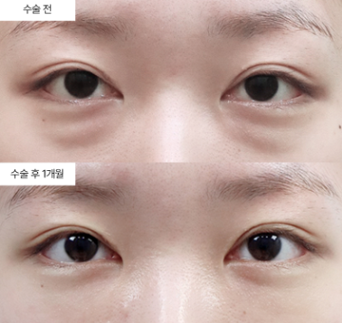 눈밑지방재배치 병원, 방법을 하나만 권하는 곳이라면 다시 보세요