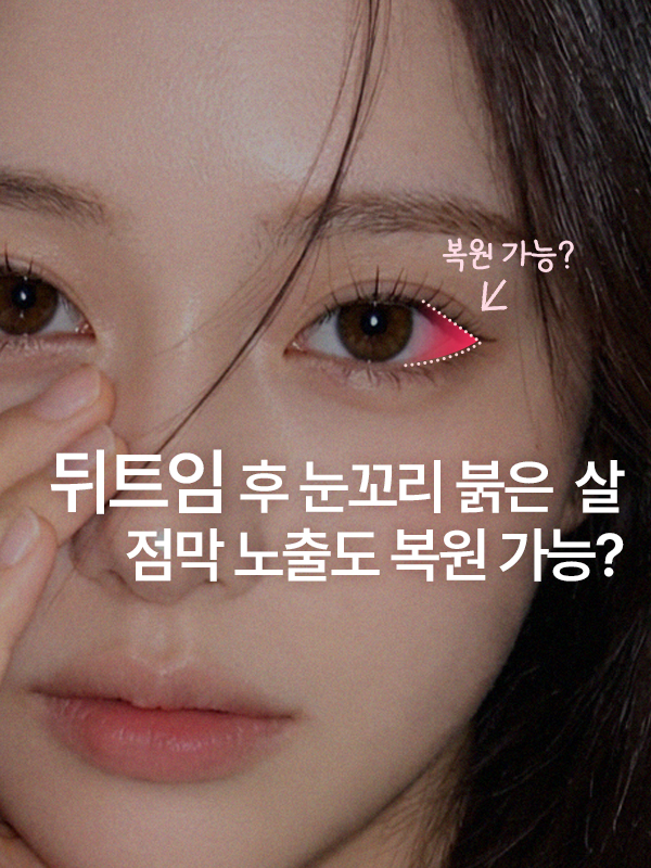 뒤트임 후 눈꼬리에 흉터처럼 붉은 살이 보여요, 뒤트임 복원이 가능할까요?