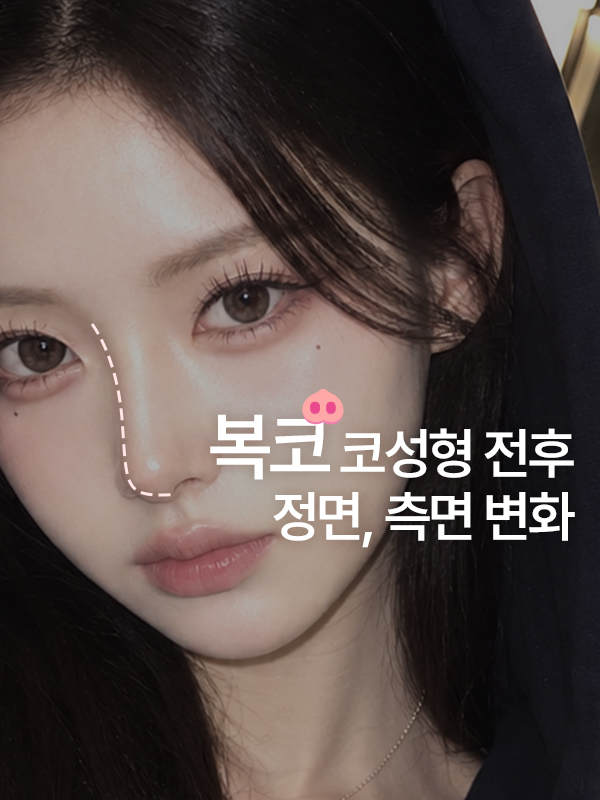 복코 코성형 전후, 정면과 측면 중 어디에서 변화가 더 클까요?