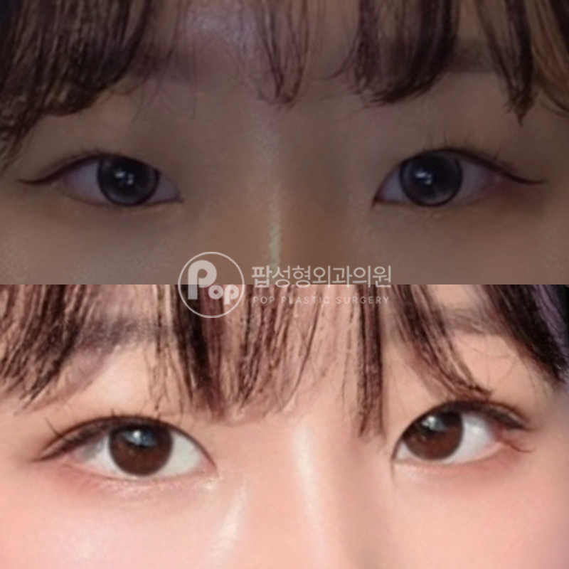 팝성형외과 자연스러운 자연유착 후기