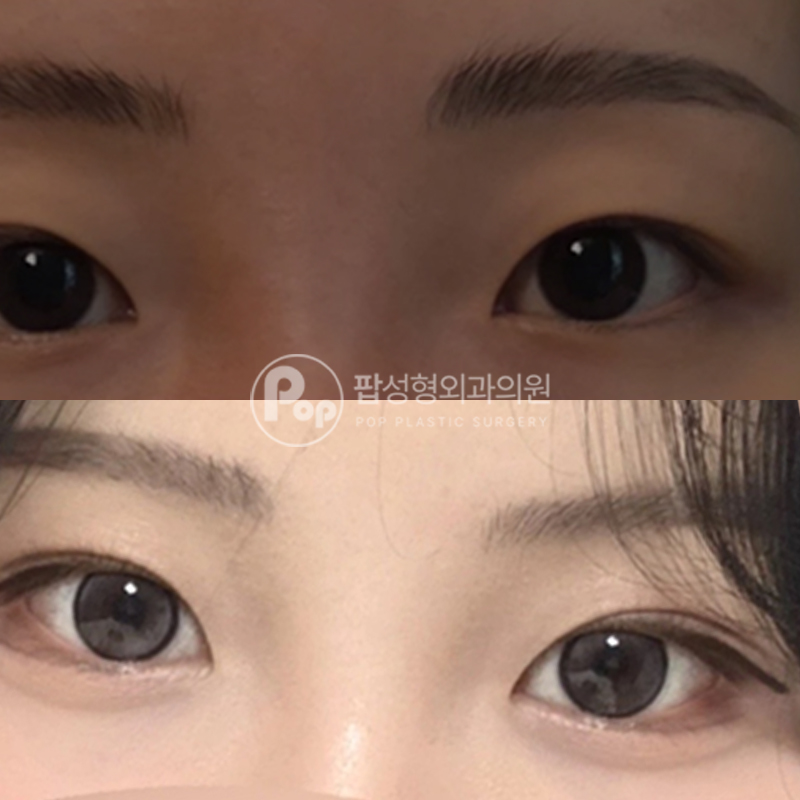 팝성형외과 짝눈 쌍수 후기