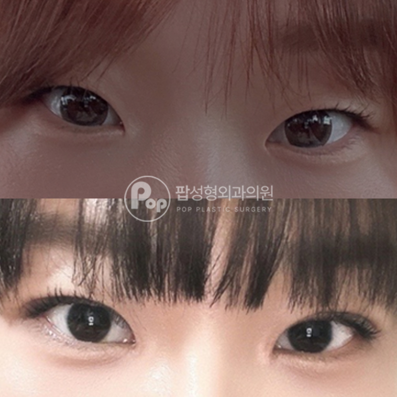팝성형외과 무쌍에서 인라인 자연유착 후기