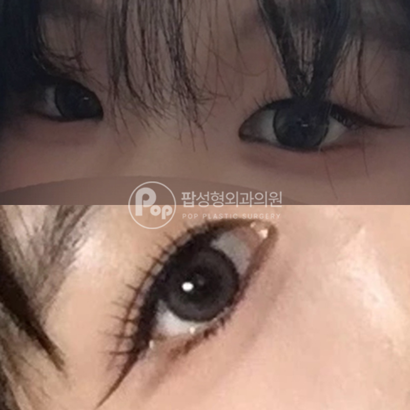 팝성형외과 안검하수 개선 후기