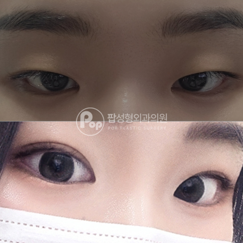 팝성형외과 안검하수 자연유착 후기