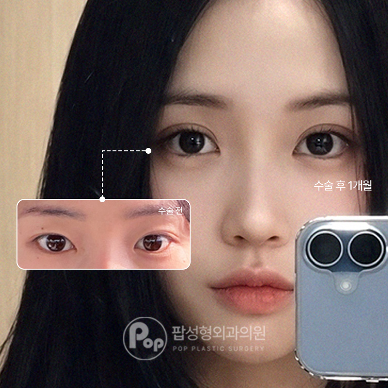 팝성형외과 세미아웃라인 자연유착 쌍수 2주차 후기