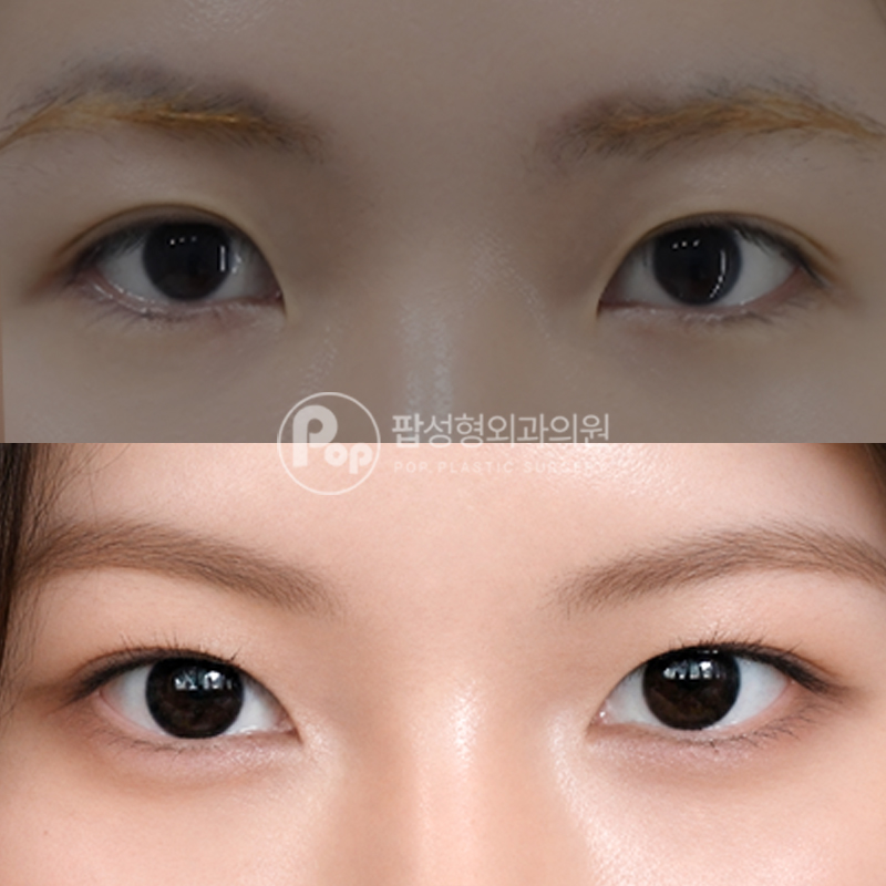 팝성형외과 몽고주름 트임 후기