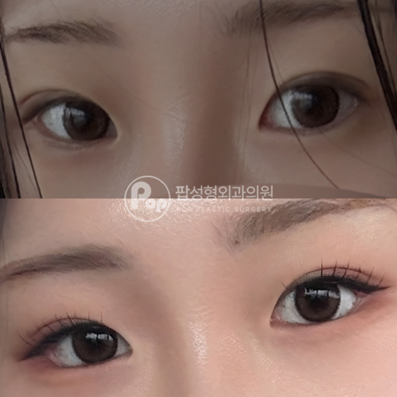 팝성형외과 뒤밑트임 후기