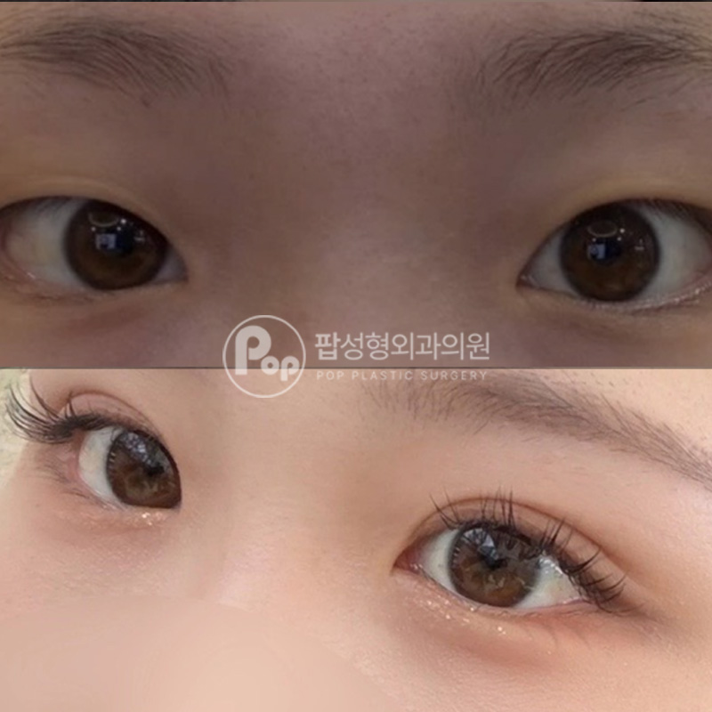 팝성형외과 첫눈 밑트임 위트임 자연유착 눈성형 4개월차