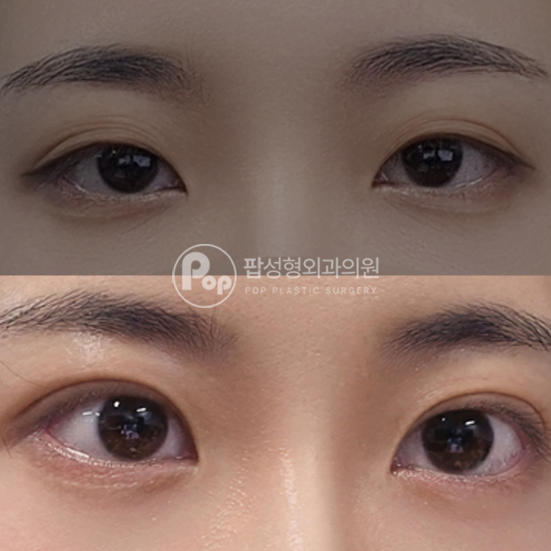팝성형외과 겹주름 자연유착 후기