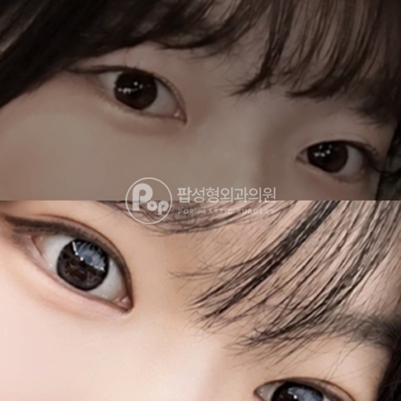 팝성형외과 눈매교정 자연유착 트임 후기