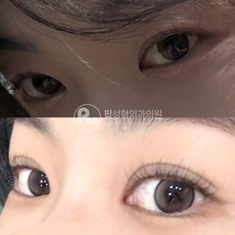 팝성형외과 짝눈 고민 해결 2개월