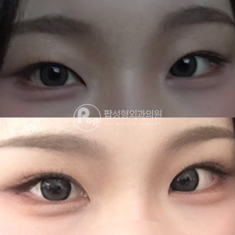 팝성형외과 첫눈성형 자연유착 후기