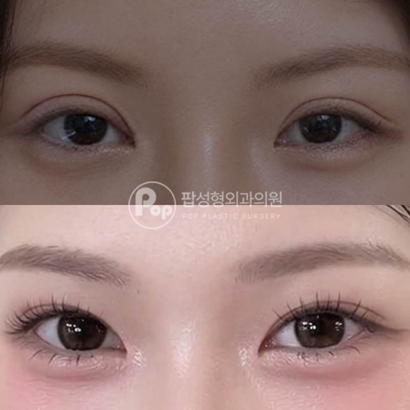 팝성형외과 소세지라인 눈재수술 3개월차 후기