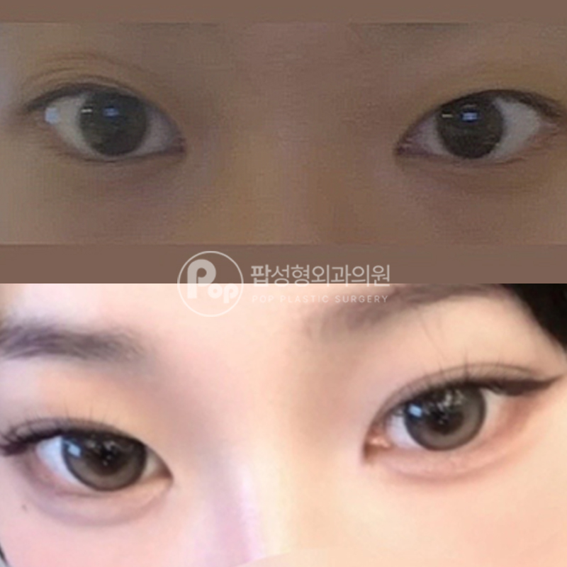 팝성형외과 인아웃 자연유착 매몰 후기