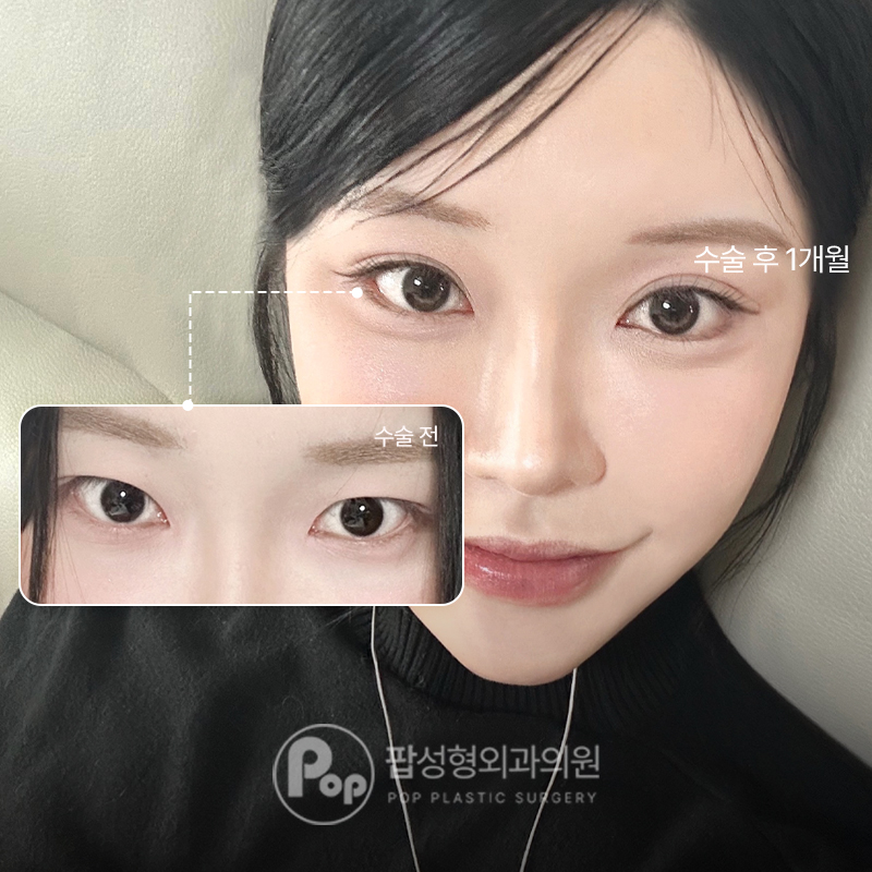 팝성형외과 속쌍에서 세미아웃 자연유착 후기