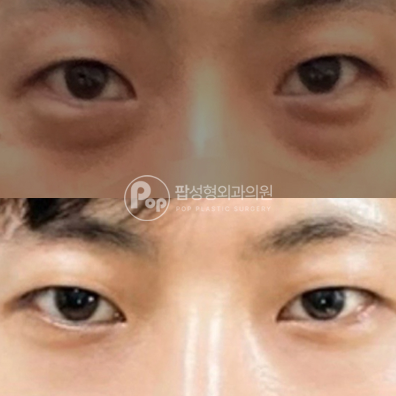 팝성형외과 남자 눈밑지방재배치 후기