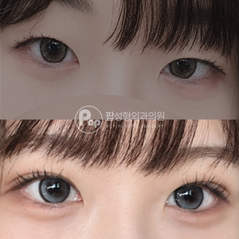 팝성형외과 작은눈 쌍수 후기