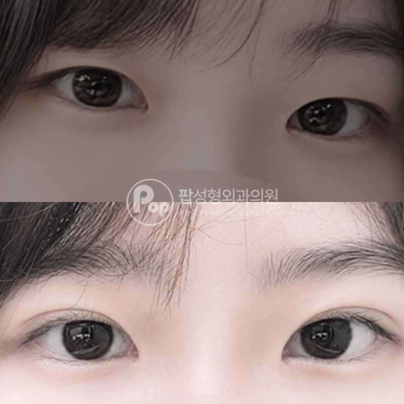팝성형외과 인아웃라인 쌍수 후기