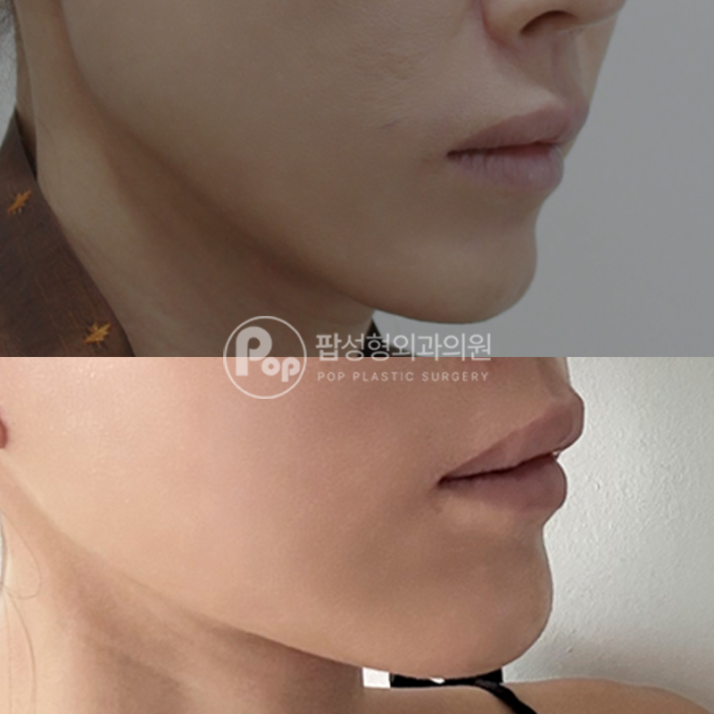 팝성형외과 심부볼 처짐 안면거상 1개월차 후기