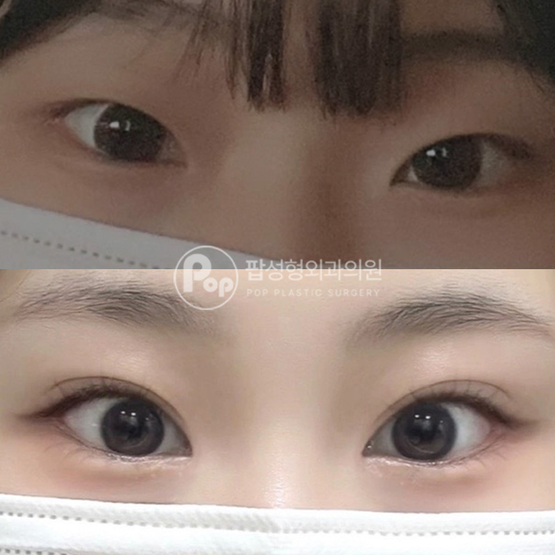 팝성형외과 사나운눈 자연유착 매몰 앞윗트임 뒤밑트임