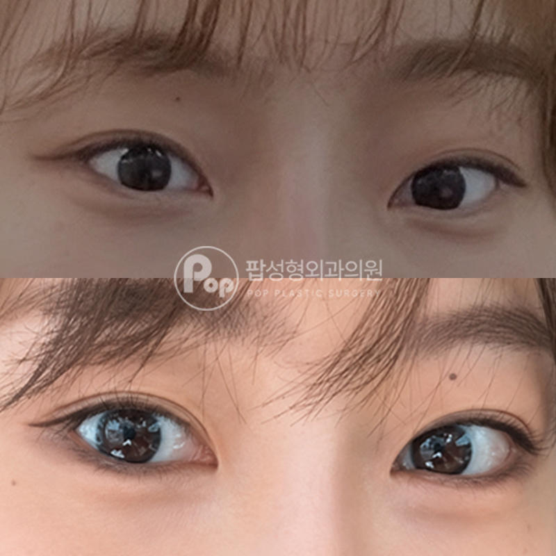 팝성형외과 트임 자연유착 후기