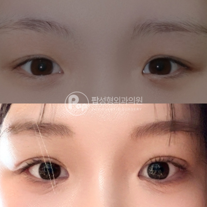 팝성형외과 겹쌍커풀 자연유착 후기