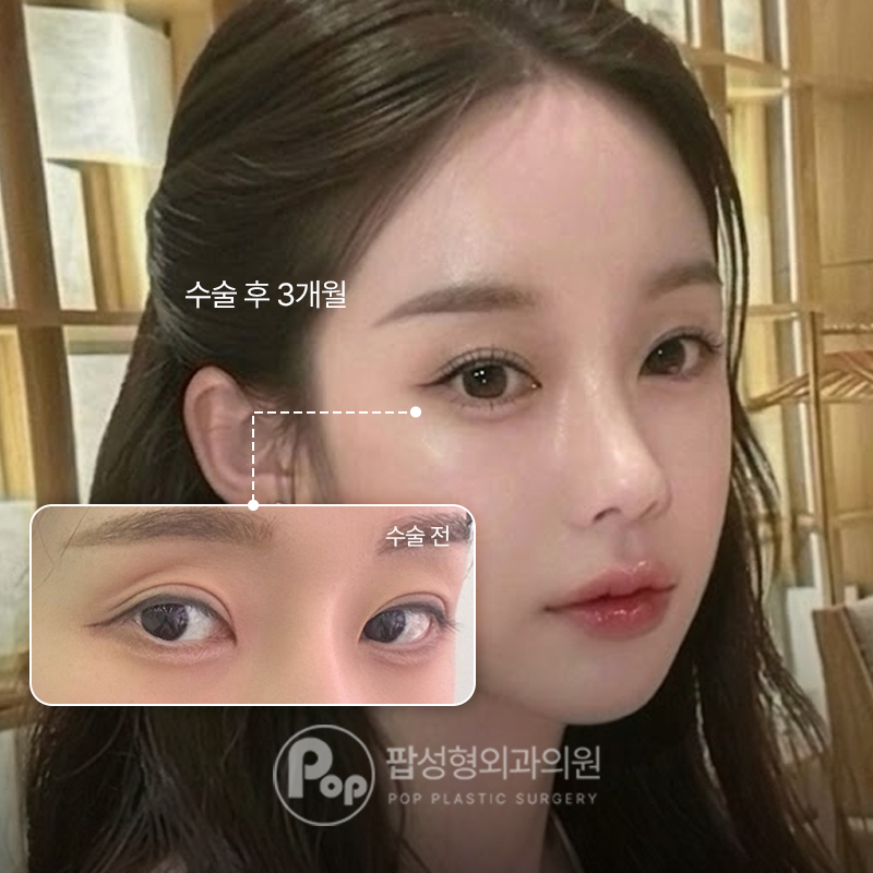 팝성형외과 함몰눈 자연유착 트임 눈재수술 후기