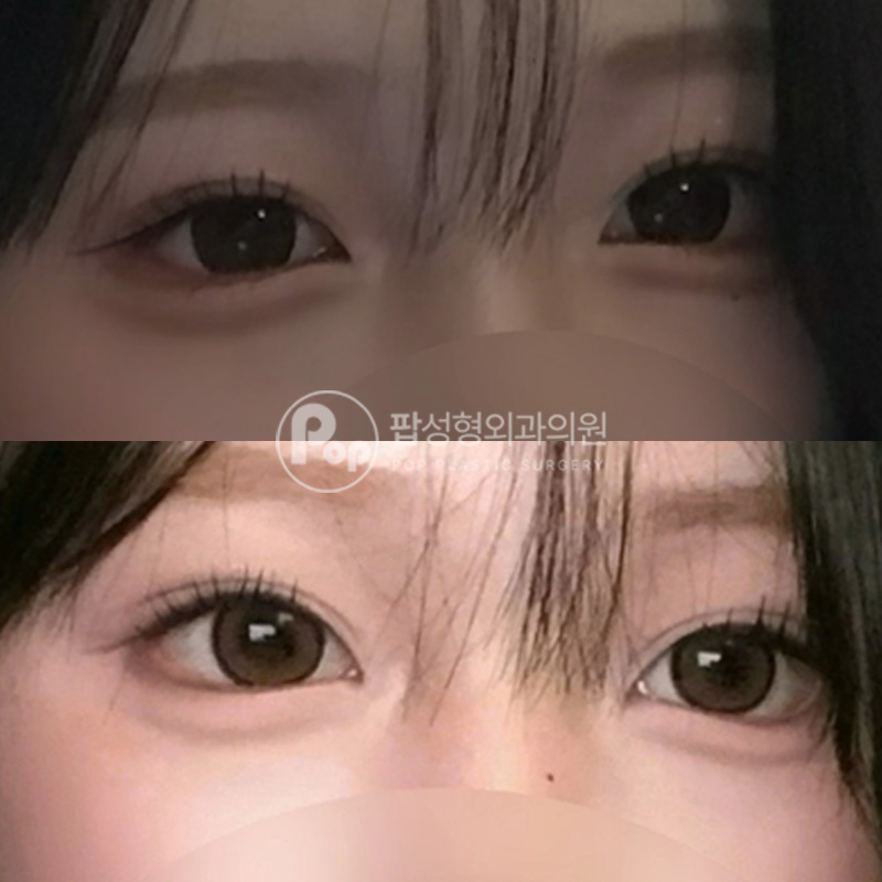팝성형외과 세미아웃 눈재수술 1달차