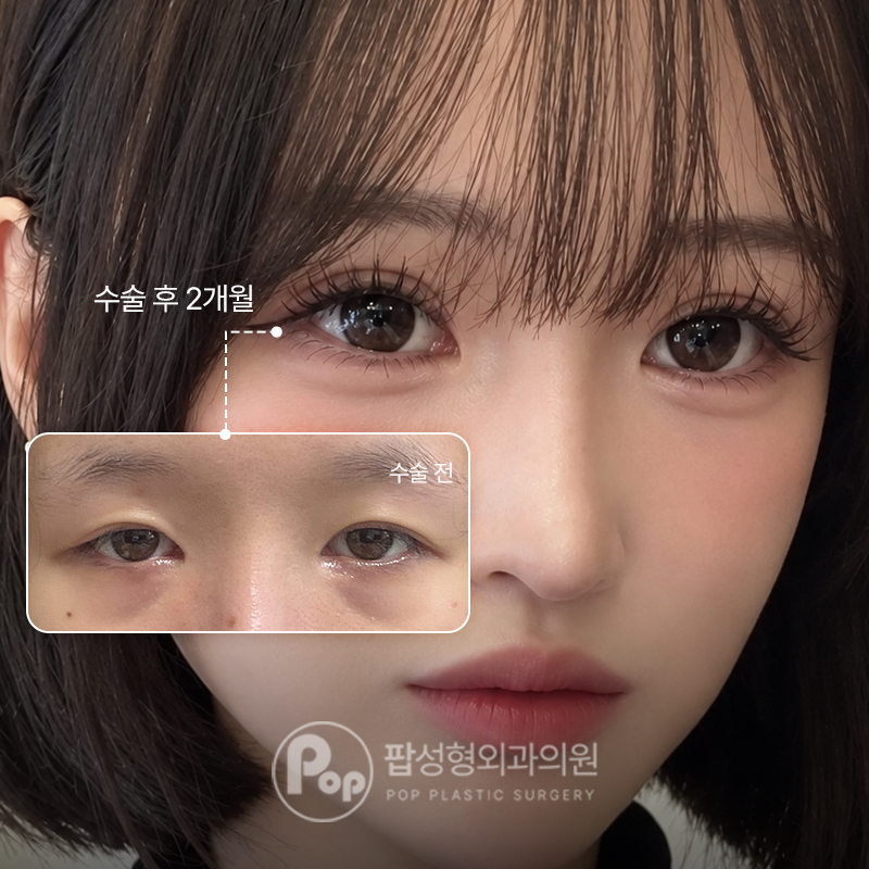 팝성형외과 처진 눈, 졸린 눈 눈재수술 후기