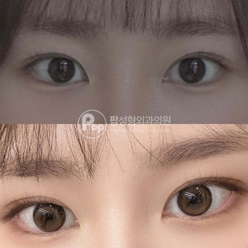 팝성형외과 눈매교정 자연유착 매몰 후기