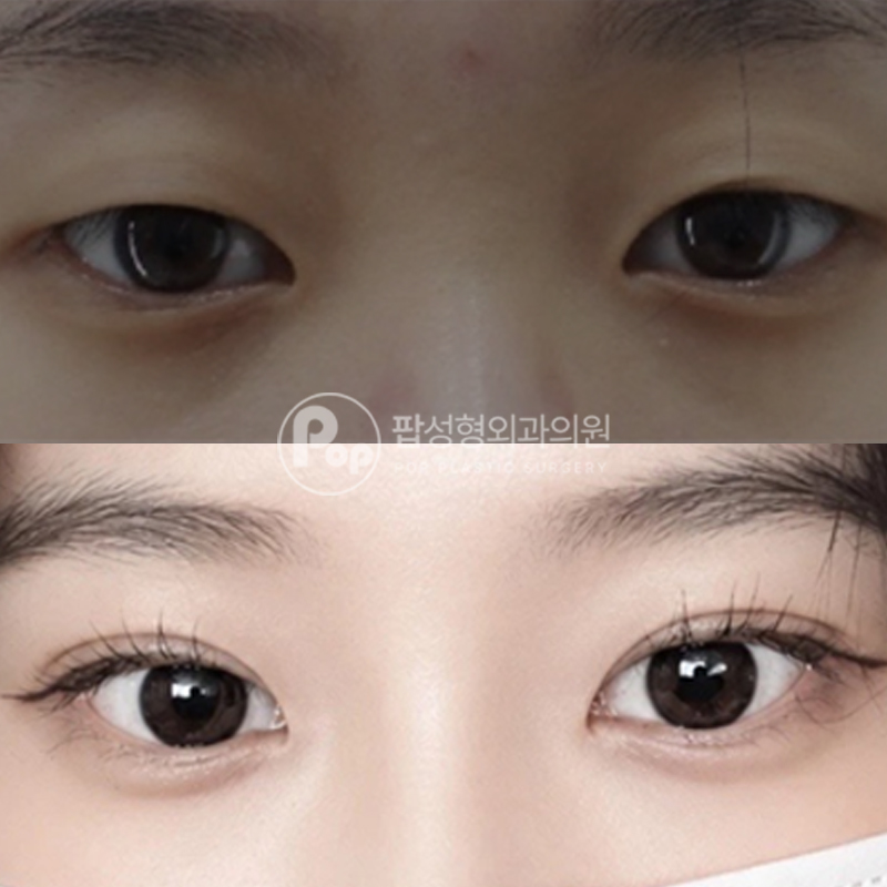 팝성형외과 무쌍 인아웃라인 쌍커풀 수술 후기