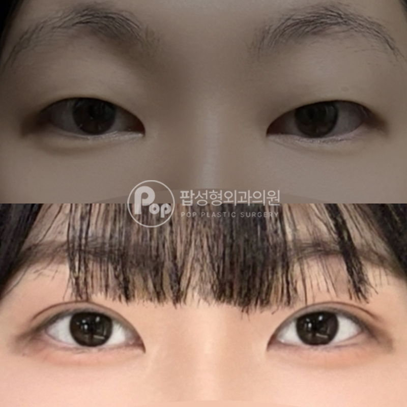 팝성형외과 무쌍에서 인아웃라인 자연유착 후기