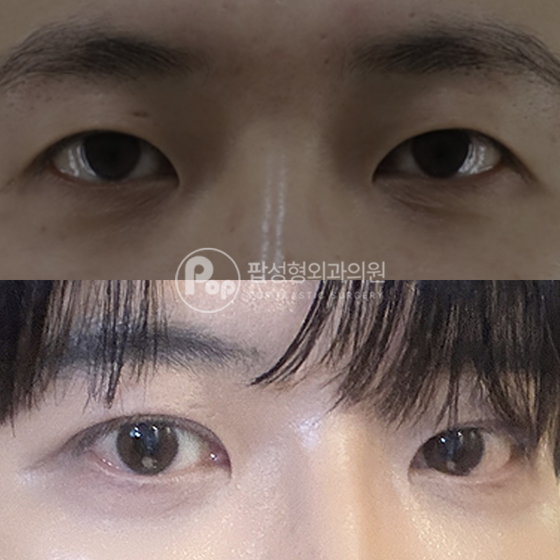 팝성형외과 남자 이마거상 후기