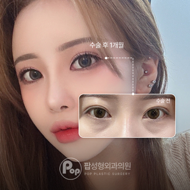 팝성형외과 자연유착 눈밑지방재배치 후기