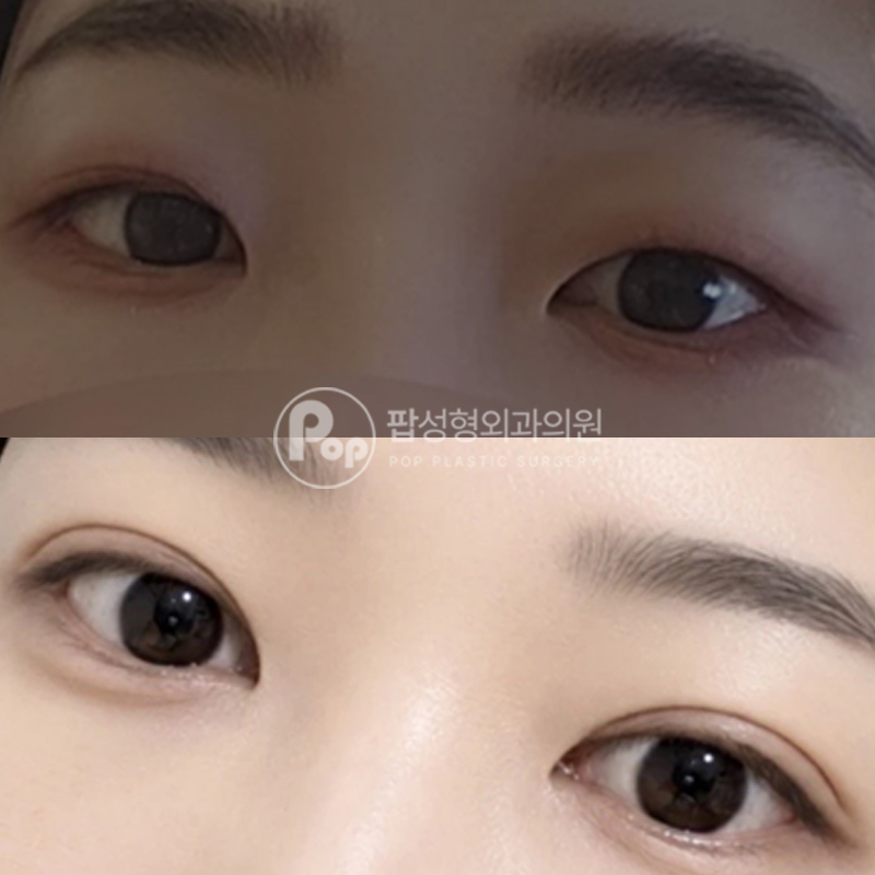 팝성형외과 무쌍 짝눈 쌍꺼풀수술 후기