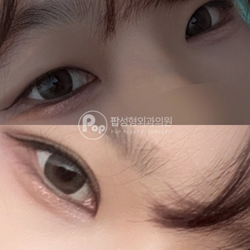 팝성형외과 작은 눈 자연유착 트임 후기