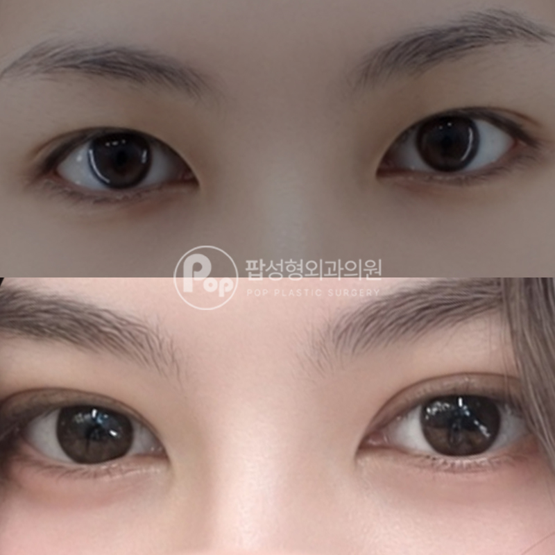 팝성형외과 인아웃라인 자연유착 2주차 후기