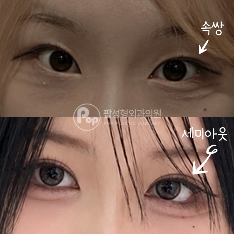 팝성형외과 속쌍 쌍수 매몰 뒤밑트임 후기