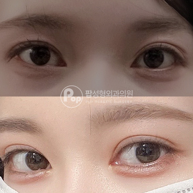 팝성형외과 겹쌍꺼풀 자연유착 후기