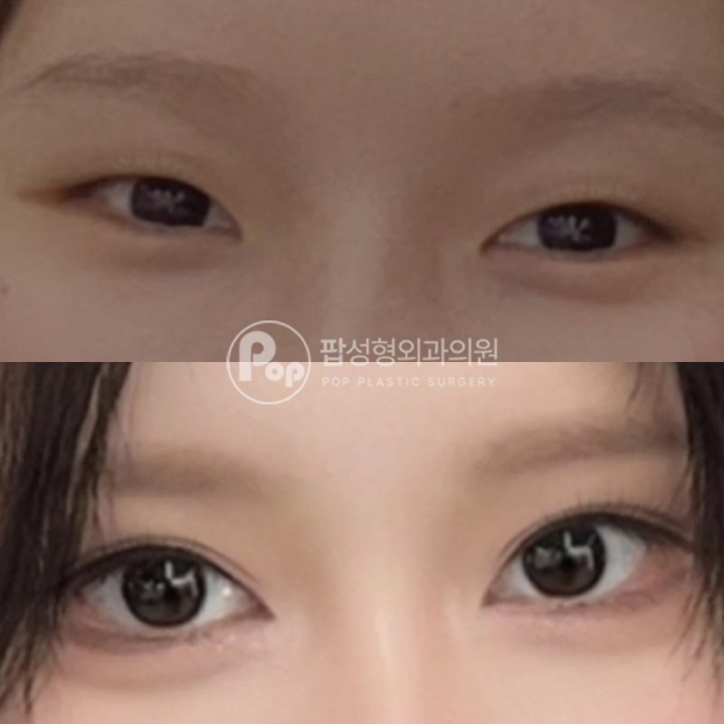 팝성형외과 꼬막눈 자연유착 트임 눈성형 후기
