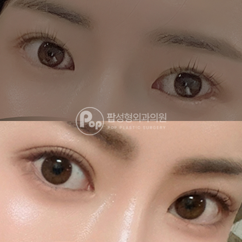 팝성형외과 풀린 라인 자연유착 후기