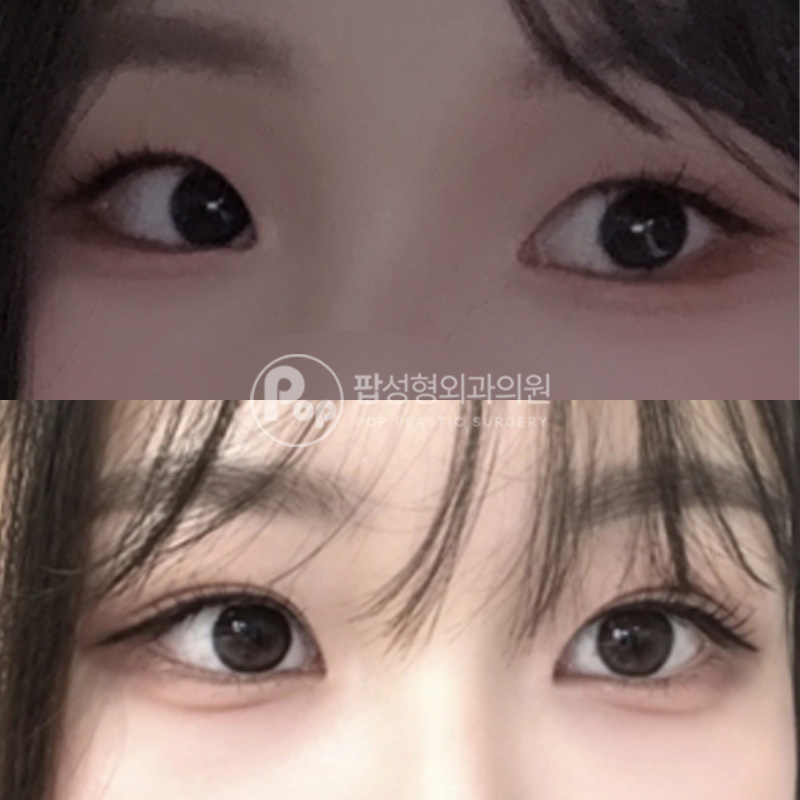 압구정 팝성형외과 자연유착 몽고트임 2달차