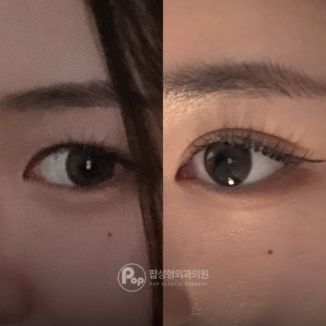 팝성형외과 세미아웃 매몰 눈성형 후기