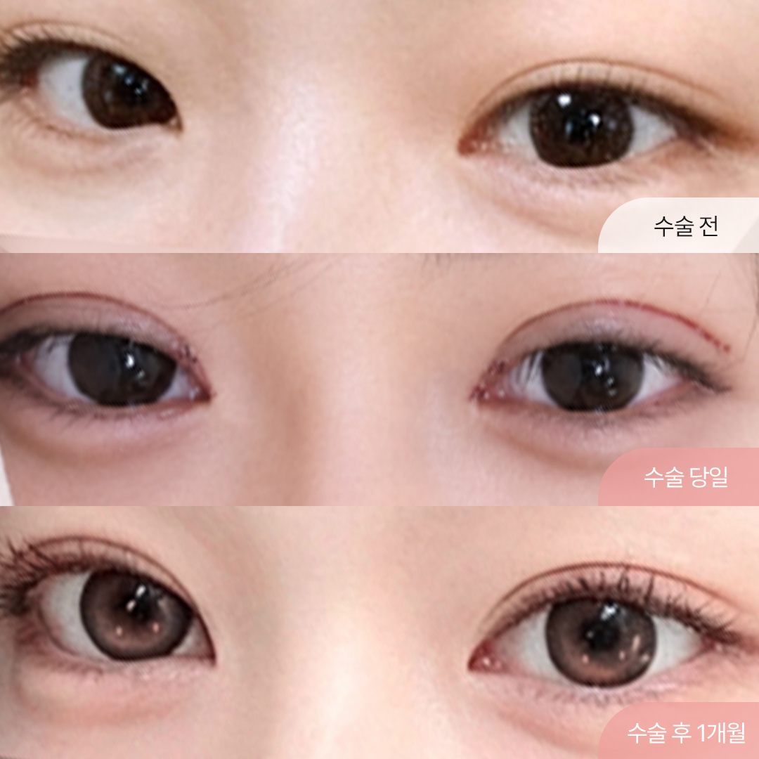 팝성형외과 세미아웃 자연유착 1개월차 경과별 후기