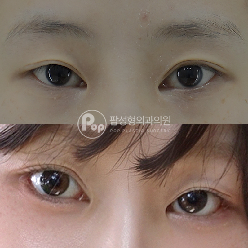팝성형외과 이마축소거상 후기