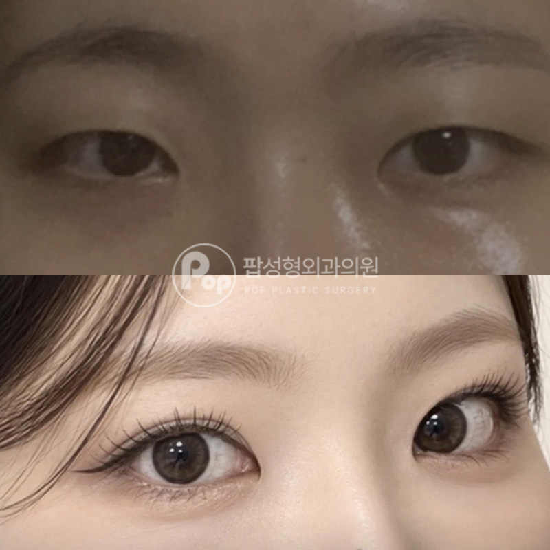 팝성형외과 눈성형 졸린눈 3개월차 리얼후기