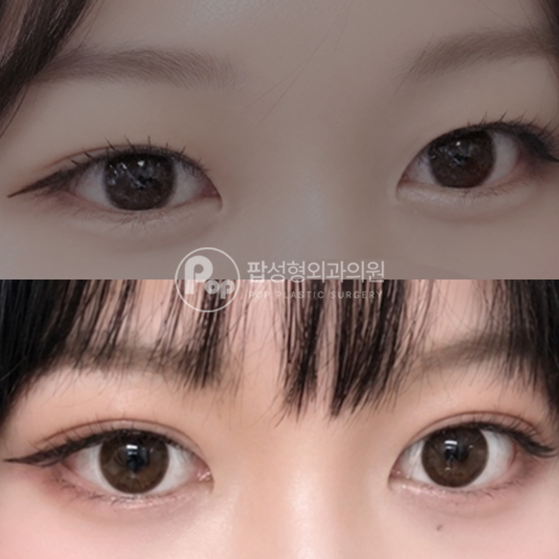 팝성형외과 세미아웃 자연유착 후기