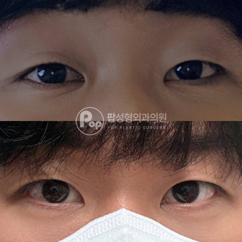 팝성형외과 남자 무쌍 자연유착 후기