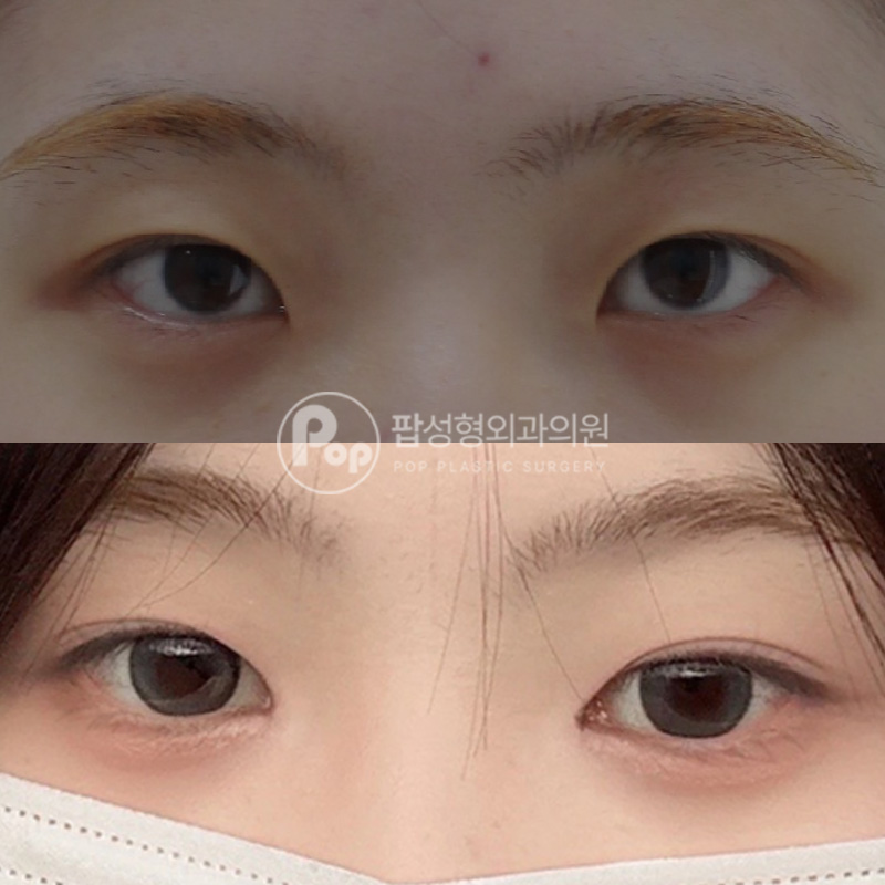 팝성형외과 앞트임 윗트임 2달차 후기
