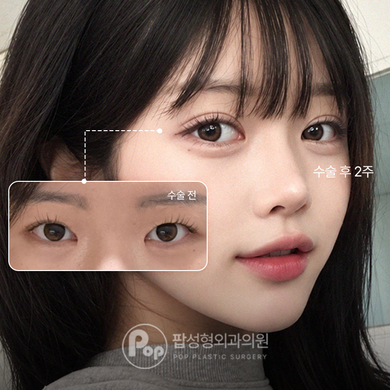 팝성형외과 인아웃 자연유착 눈재수술 경과별 회복 후기